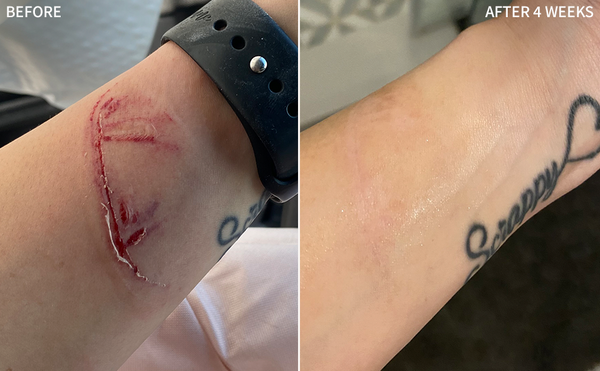 before-and-after image of a man's wrist, illustrating the visible reduction of an accidental scar in the 'before' image and the clear and healed skin in the 'after' image after using the RescueMD serum for 4 weeks