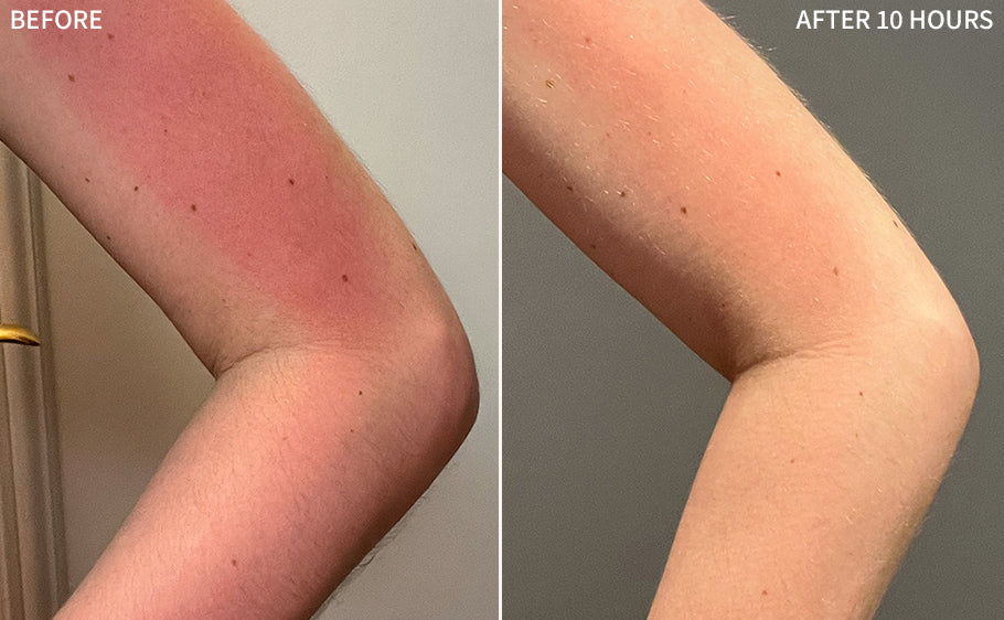 before and after comparison of a man's arm with sunburn and redness, showing significant healing only after 10 hours of using RescueMD serum 