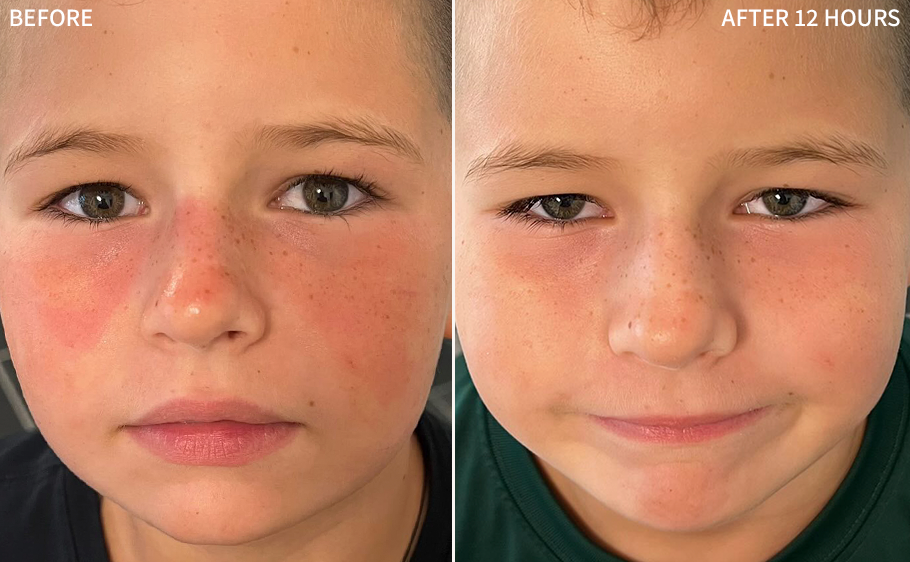 an evident before and after image of a kid's face affected with sunburn, the after image showcasing the remarkable transformation after 10 hours of using the RescueMD serum