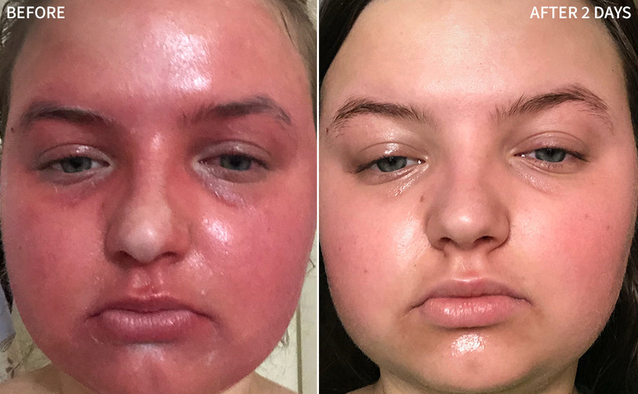 striking before-and-after image of a girl's face, showcasing the contrast between the effects of sunburn on her skin in the 'before' image, and the remarkable improvement in the 'after' image after using the RescueMD serum for just 2 days