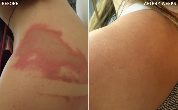 before and after images of a woman's shoulder burnt badly and having redness and burn mark in the before image, and the after image showing a 100% transformed shoulder with no burning marks, its only after using tje RescueMD for 4 weeks