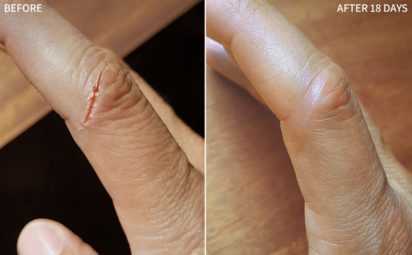 a before-and-after image showcasing the remarkable healing power of the RescueMD serum on a finger cut