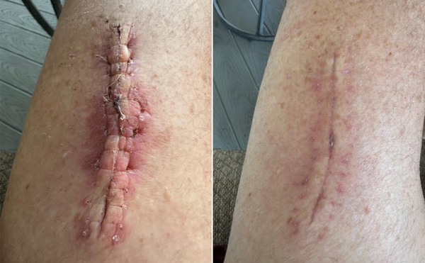 Surgical Scar | 12 Days