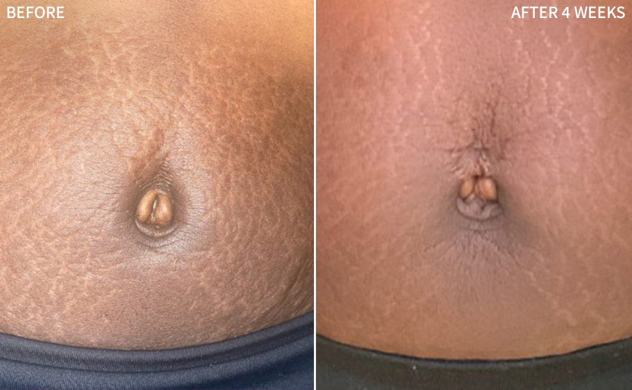 a before and after comparison of a belly button having some stretch marks and acne scars, and the after image showing  significant improvement after using the RescueMD only for 4 weeks