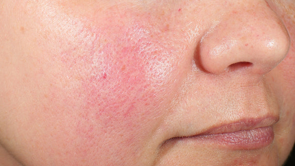 A Dermatologist Explains Your Skin Barrier