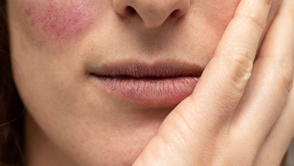Insights & Tips on Rosacea from Dr. Suzman