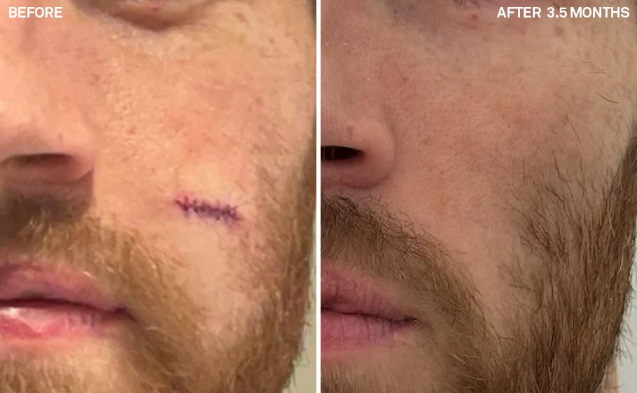 Before and after comparison of a man's cheek showing remarkable healing progress. The 'Before' image displays a recent surgical incision secured with visible purple sutures. The 'After 3.5 Months' image shows the same area fully healed, with the facial scar minimized and nearly invisible.