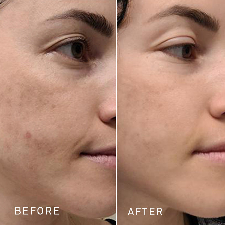 a before and after comparison of a woman's face with small acne blemishes and melasma, showing significant healing after using RescueMD serum