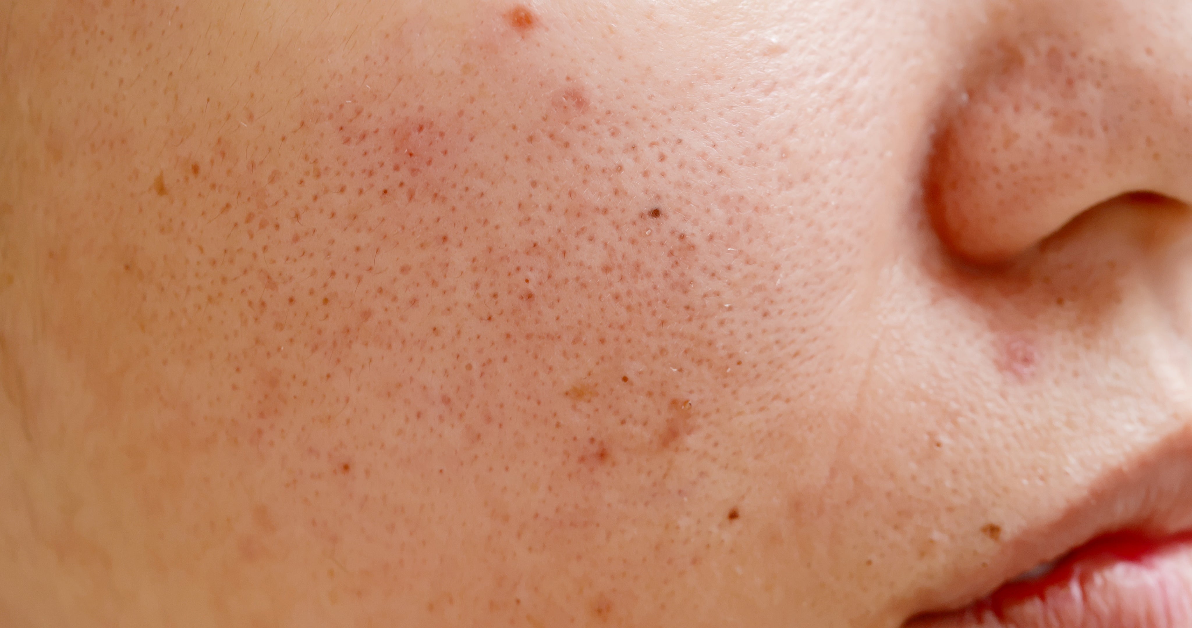 close-up of a woman's face with multiple small acne dots