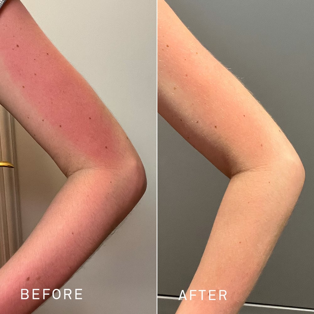 before and after comparison of a woman's arm with sunburn and redness, showing significant healing after using RescueMD serum