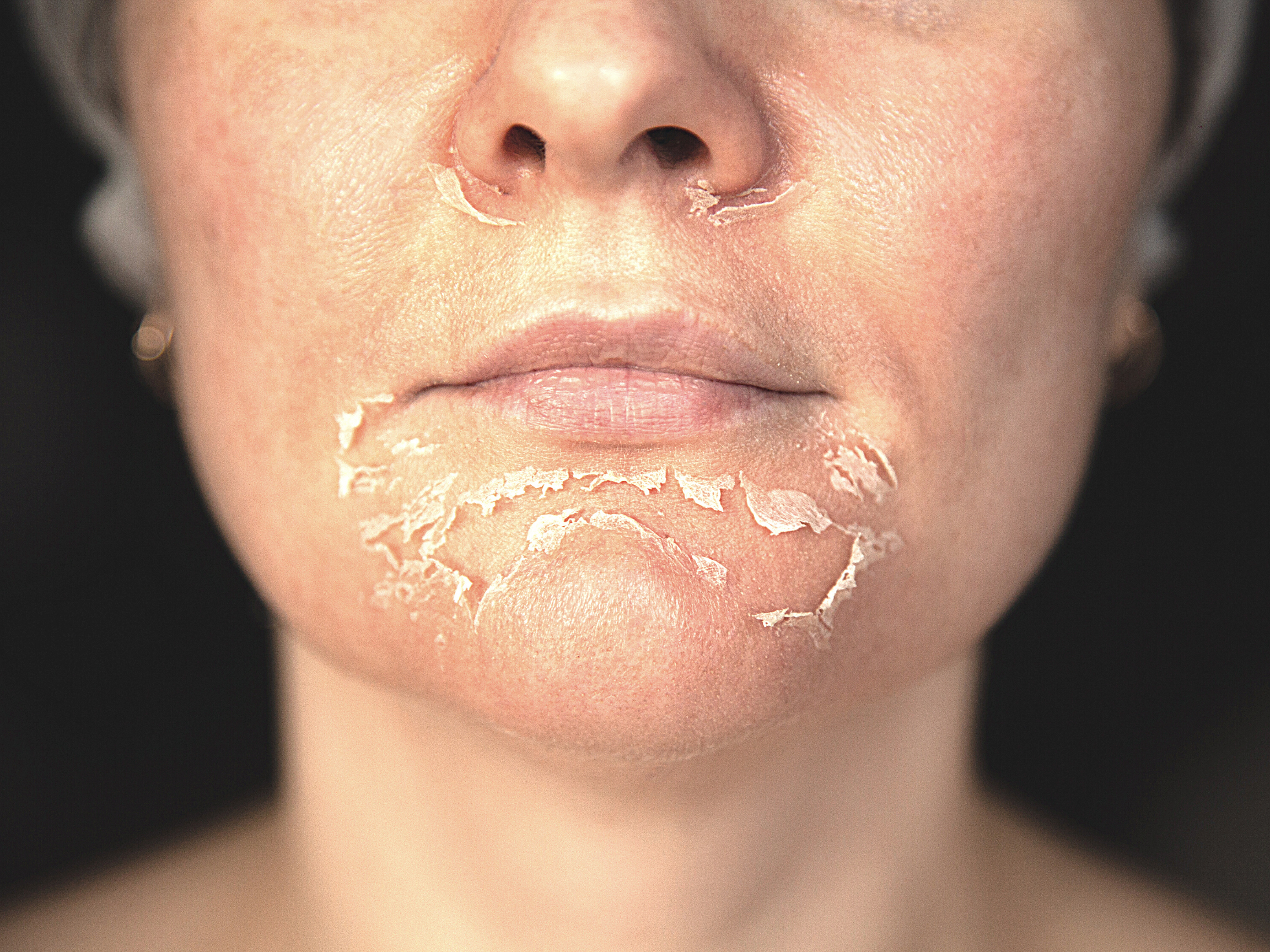 woman after a chemical peel with peeled-off dead skin