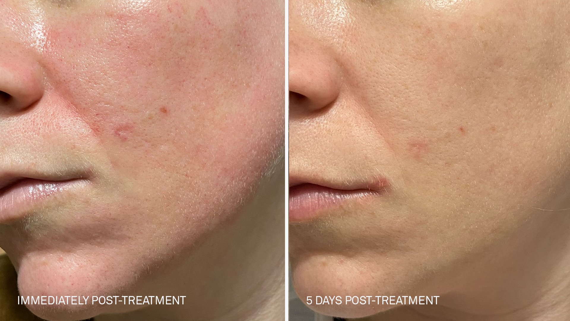 a clear before and after comparison of a woman's face immediately after microneedling treatment with redness, and 5 days post treatment, now the face is significantly clear and by using the RescueMD serum