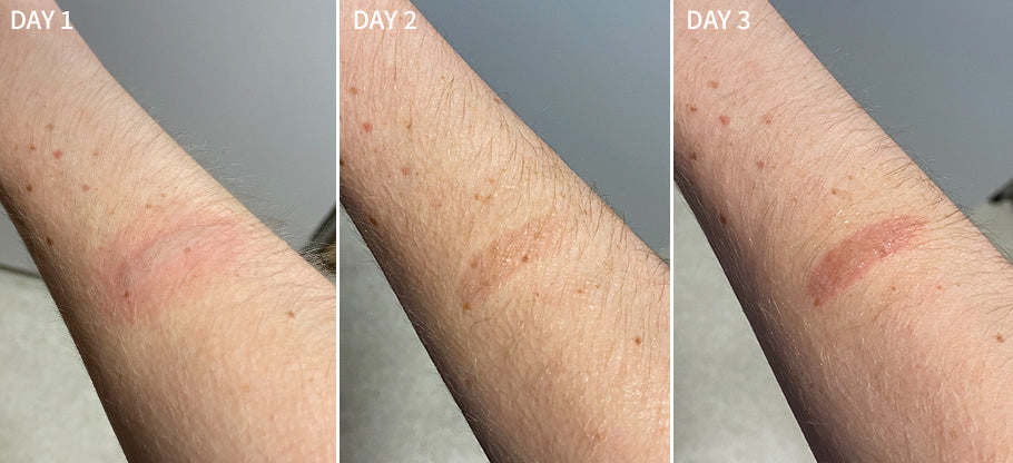 a comprehensive before and after comparison of a human wrist that burnt badly,  healed and recovered significantly after using the RescueMD serum only for 10 days