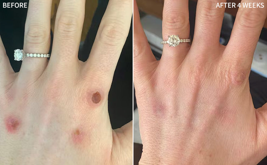 a before and after comparison of a woman's hand affected with multiple surgical scars, in the after image, they are improved significantly after using the RescueMD serum only for 4 weeks