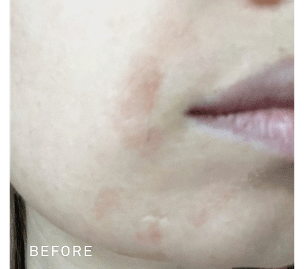 a GIF showing a woman's face with swollen, red retinoid irritation, followed by the transformation and disappearing of the redness after using the RescueMD serum
