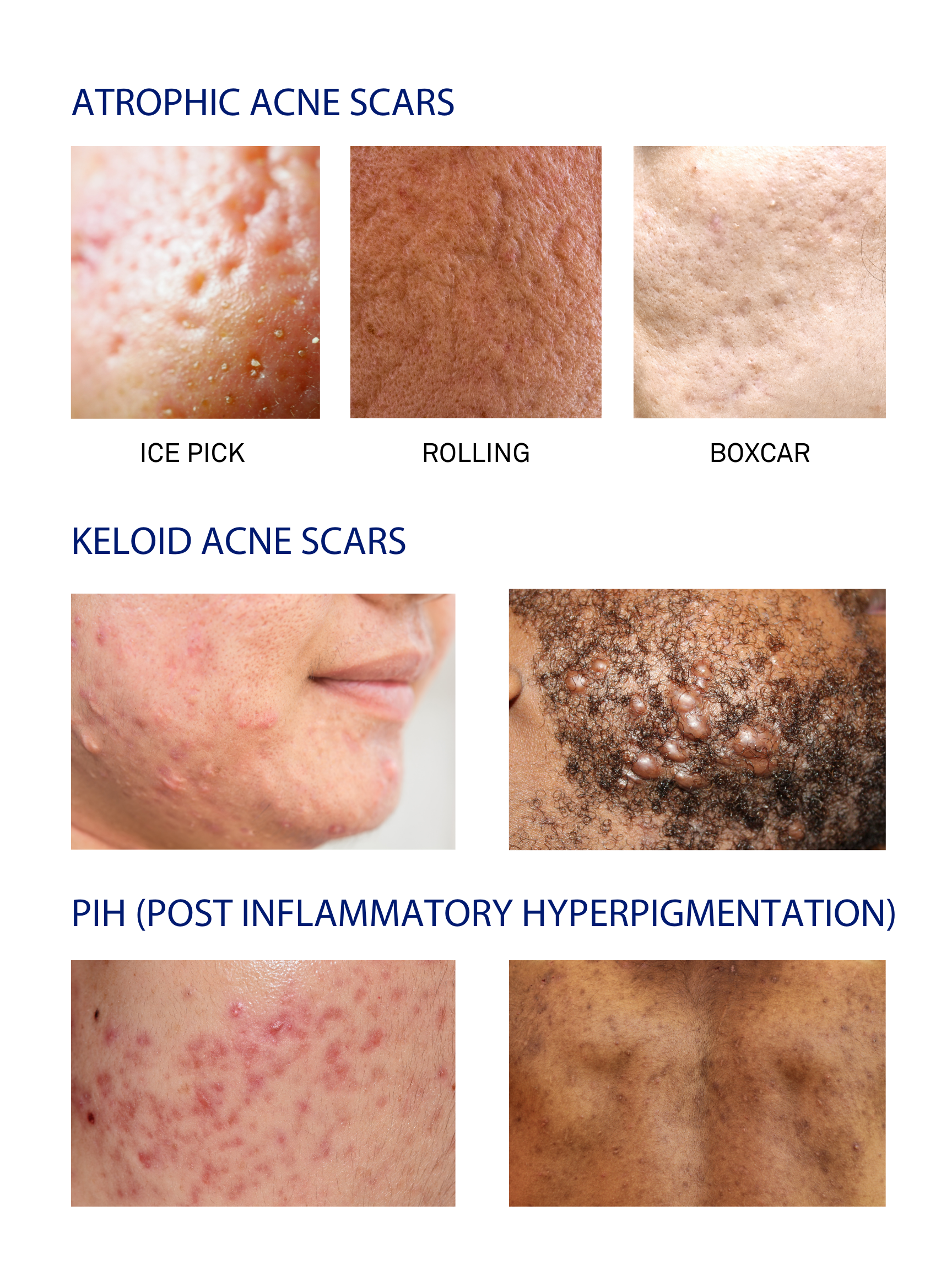 an image depicting the classifications of acne scars, including atrophic scars (such as ice pick, boxcar, and rolling scars), keloid scars, and post-inflammatory hyperpigmentation