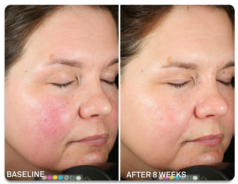 Before-and-after split comparison of a woman's face showing skin improvement, labeled 'BASELINE' on the left and 'AFTER 8 WEEKS' on the right.