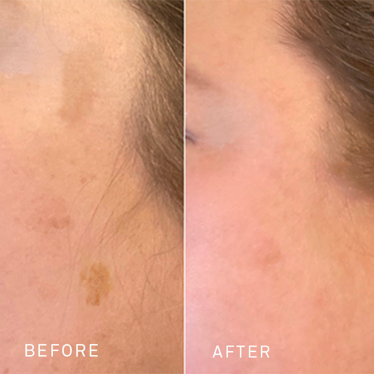 before and after comparison of a woman's face with hyperpigmentation, showing significant fading of dark spots after using RescueMD serum