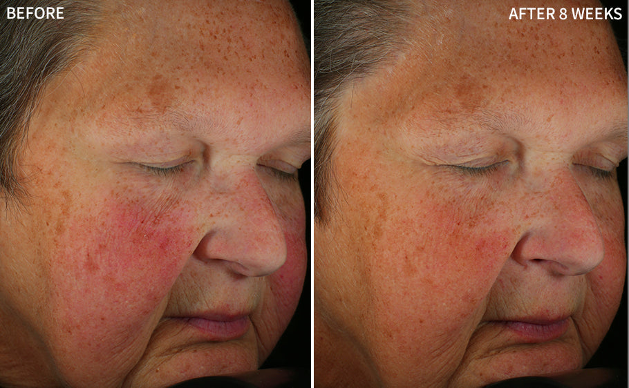 the rotated image of before and after comparison of a woman's face showing redness before and a clearer face using the RescueMD serum for 8 weeks