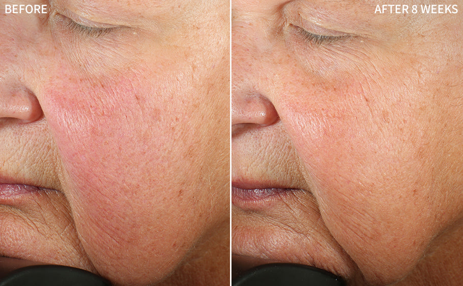 before and after images of an old women having redness on her cheeks after some treatment, and healed after using RescueMD serum only for 8 weeks as a part of a clinical trial