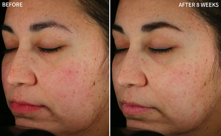 a clearer image of before and after comparison of a woman's face showing redness before and a clearer face using the RescueMD serum for 8 weeks