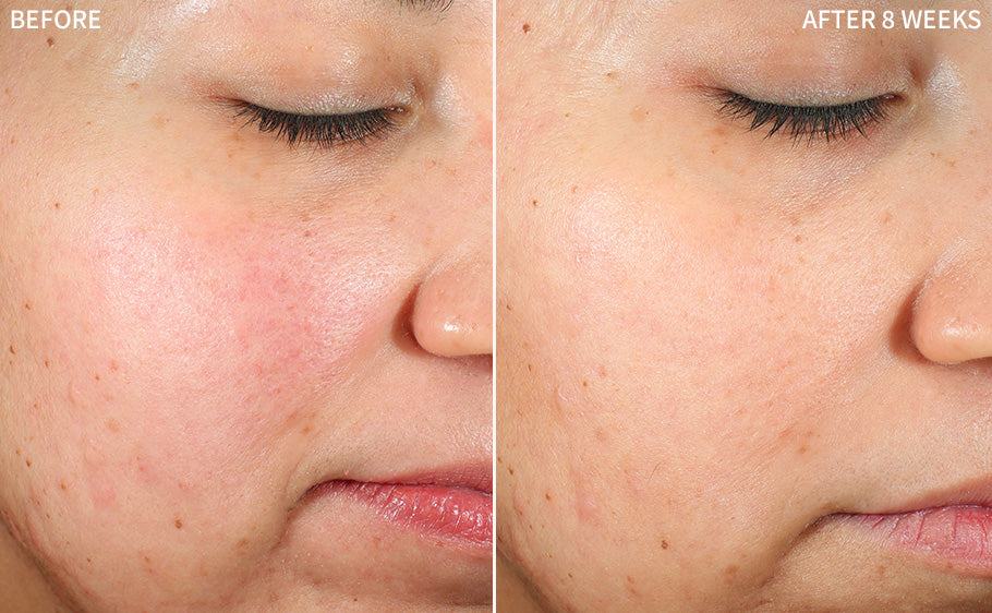 before and after images of a women having redness and acne on her cheeks, and healed after using RescueMD serum only for 8 weeks as a part of a clinical trial