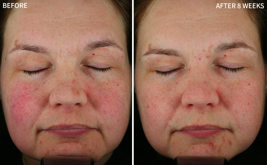 a clear comparison of a woman's face showing redness in before and a clearer face using the RescueMD serum for 8 weeks