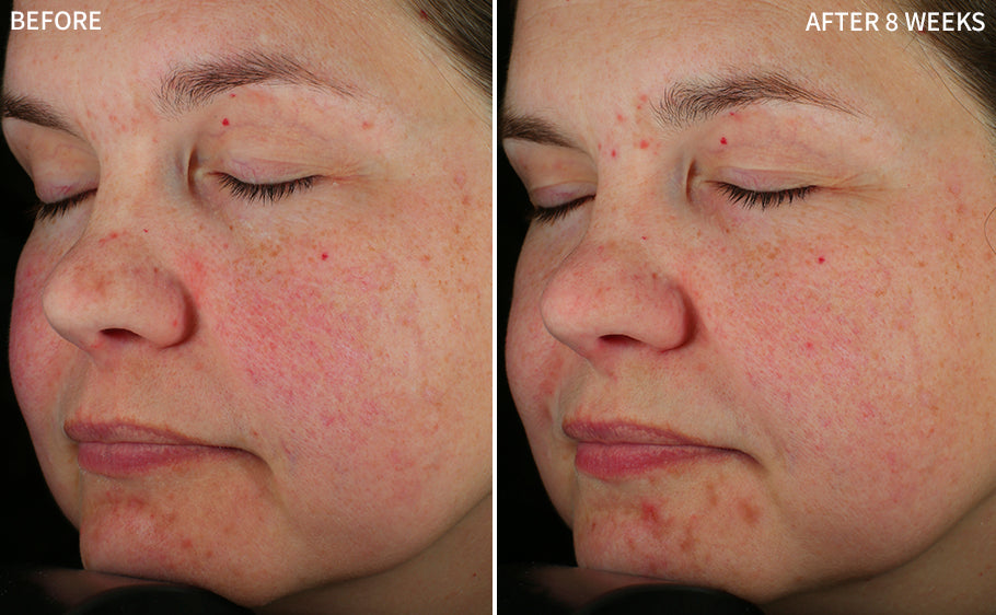 a side view of a woman's face showing redness in before and a clearer face using the RescueMD serum for 8 weeks