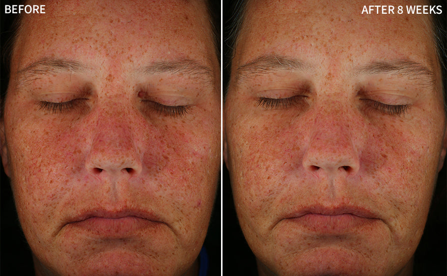 comparison of a woman's face showing redness in before and a clearer face using the RescueMD serum for 8 weeks