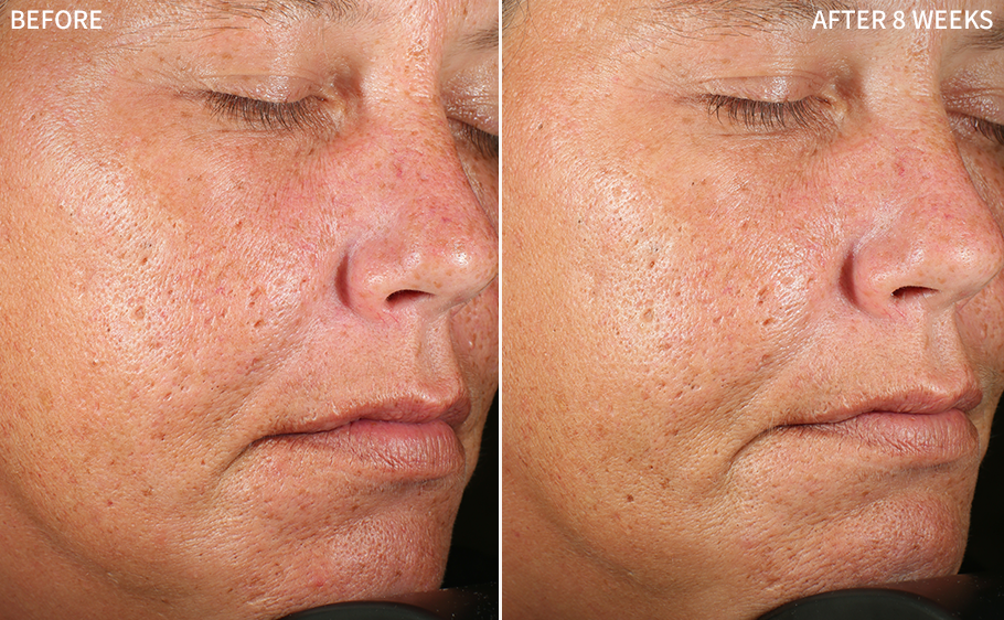 before and after images of a women having hyperpigmentation and scars on her cheeks, and healed after using RescueMD serum only for 8 weeks as a part of a clinical trial