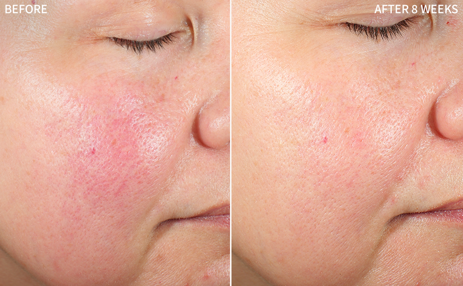 before and after images of a women having redness on her cheeks after some treatment, and healed after using RescueMD serum only for 8 weeks as a part of a clinical trial