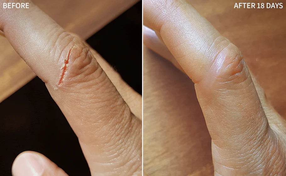 Before-and-after comparison illustrating dermal regeneration on a finger. The initial image displays a visible laceration on the knuckle joint. The subsequent image, taken 18 days later, shows complete healing of the wound with minimal residual marking.
