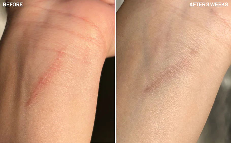 Before-and-after comparison illustrating dermal regeneration on a finger. The initial image displays a visible laceration on the knuckle joint. The subsequent image, taken 18 days later, shows complete healing of the wound with minimal residual marking.