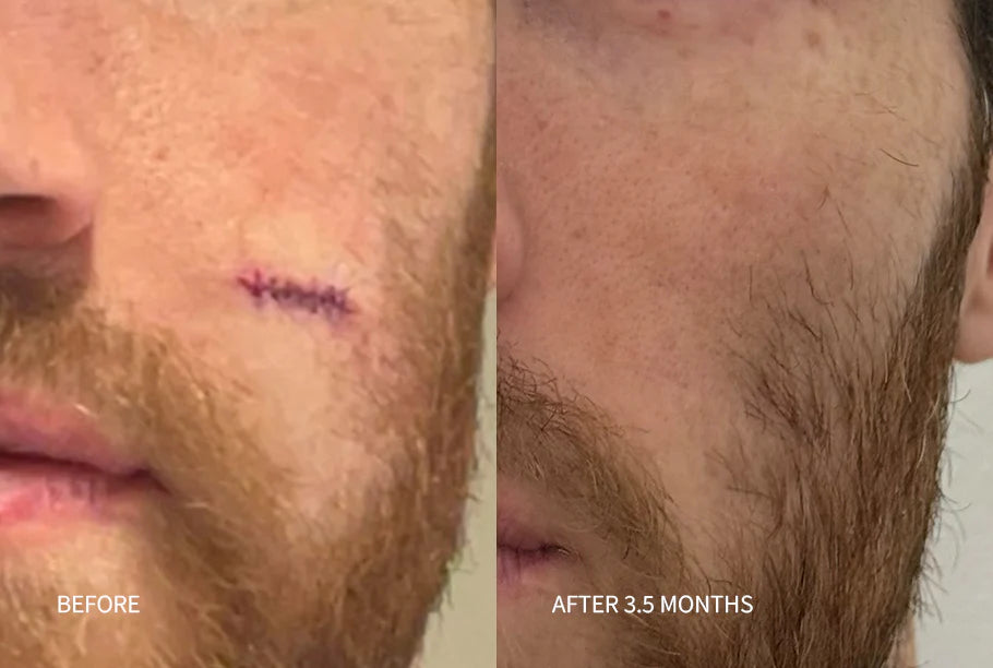 Before and After Scar Removal Serum