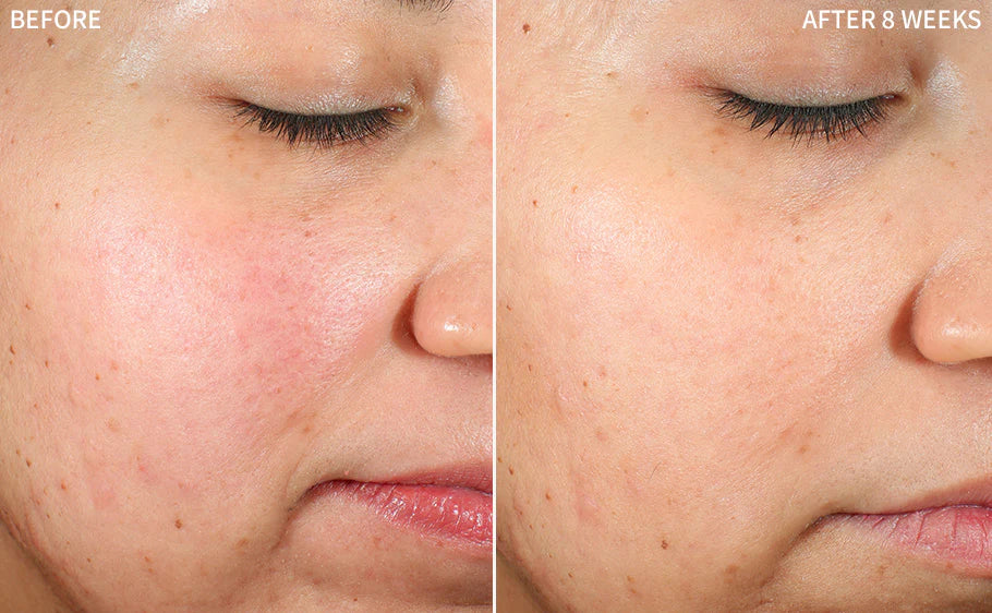 Before and After rosacea redness treatment