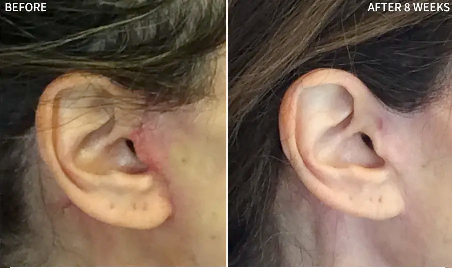 Before and after comparison of a man's cheek showing remarkable healing progress. The 'Before' image displays a recent surgical incision secured with visible purple sutures. The 'After 3.5 Months' image shows the same area fully healed, with the facial scar minimized and nearly invisible.