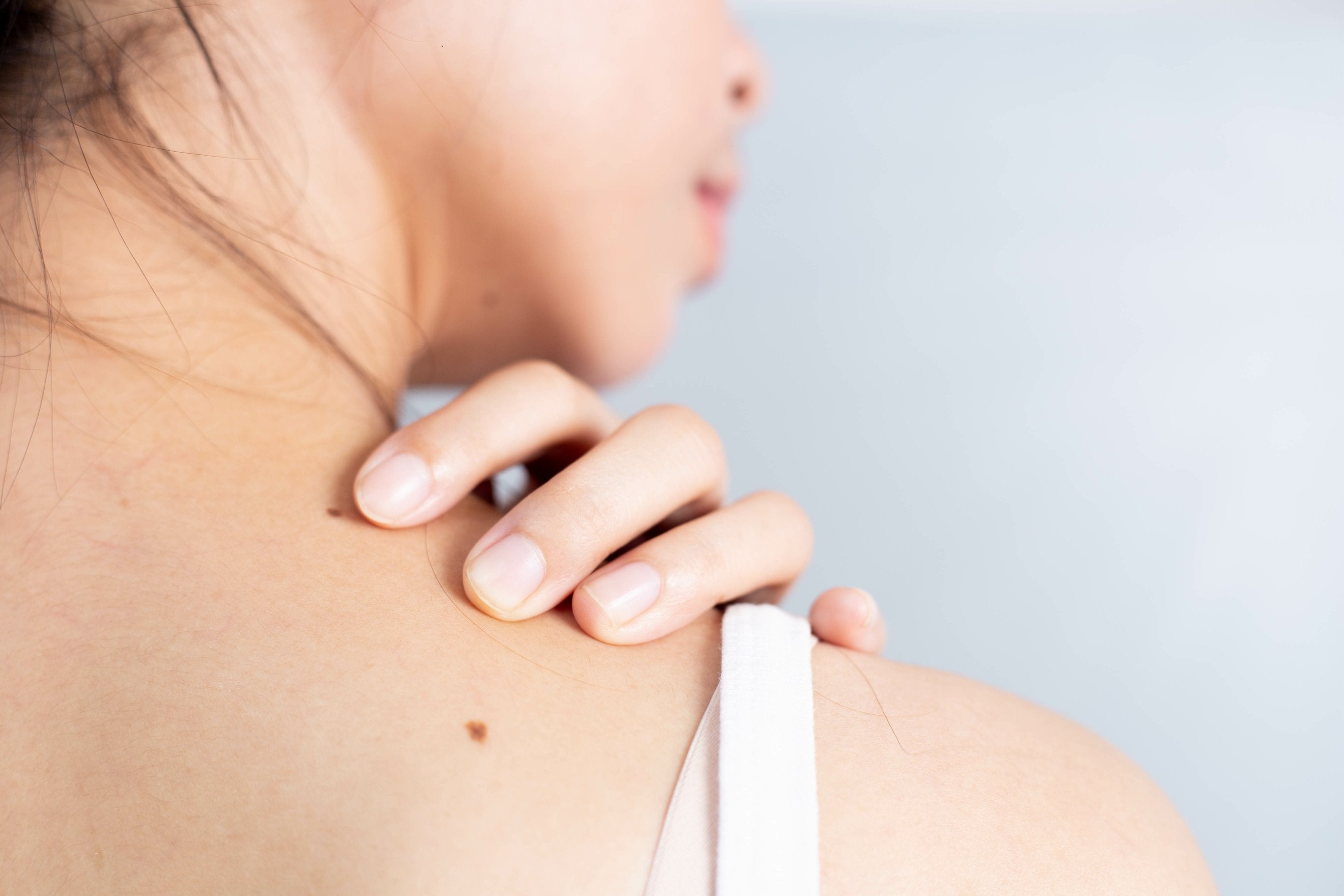 woman having couple of small scars on his shoulder and back area 