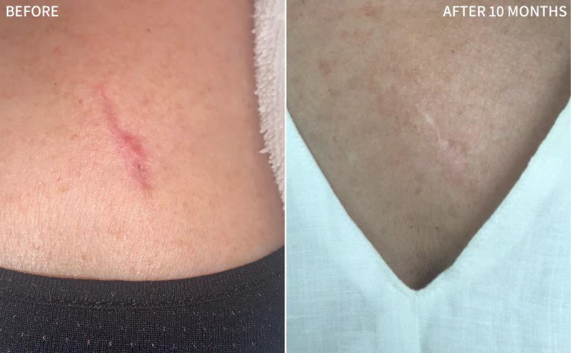 A side-by-side before-and-after comparison of a scar on a person's lower back. The left panel is labeled 'BEFORE' and shows a visible red scar.