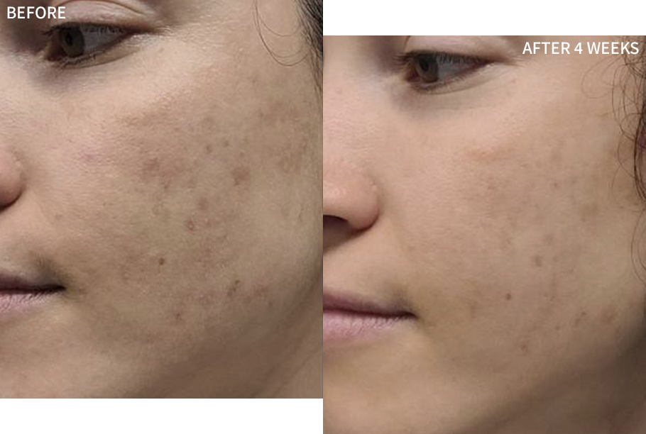 before-and-after comparison of a woman's face having acne blemishes, recovered by the RescueMD serum in just 4 weeks