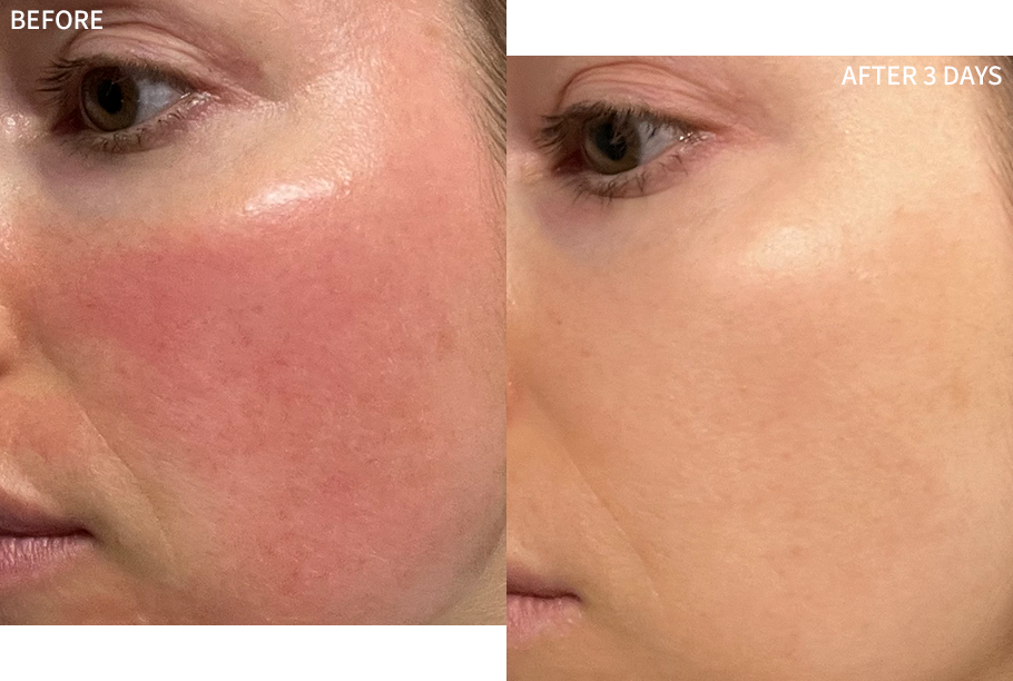 before-and-after comparison of a woman's face having post laser redness affects on her cheeks, healed significantly by the RescueMD serum in just 3 days