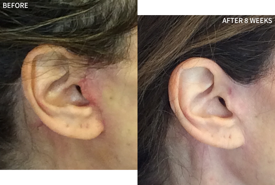 a clear before and after comparison of a woman's ear affected with a surgical scar,  healed significantly after using the RescueMD serum only for 8 weeks