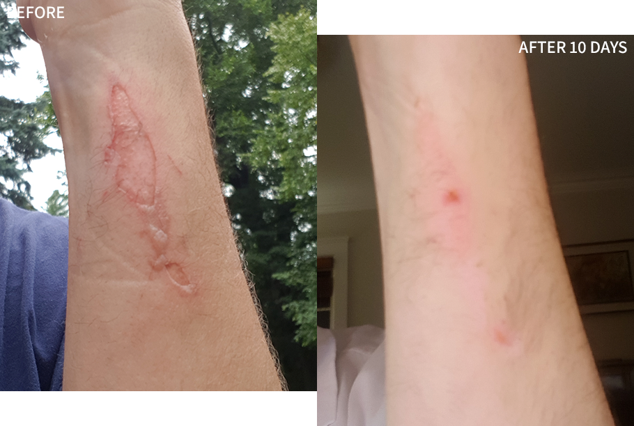 a clear before and after comparison of a man's wrist with a dark burn mark, and in the after image, it healed significantly after using the RescueMD only for 10 days