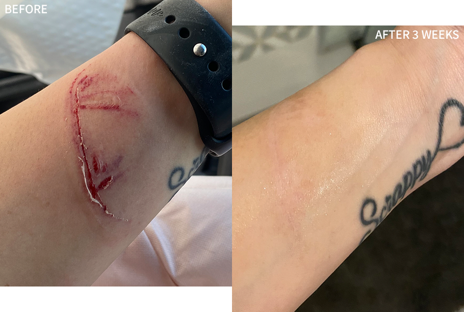 before-and-after image of a man's wrist, illustrating the visible reduction of an accidental scar in the 'before' image and the clear and healed skin in the 'after' image after using the RescueMD serum for 4 weeks