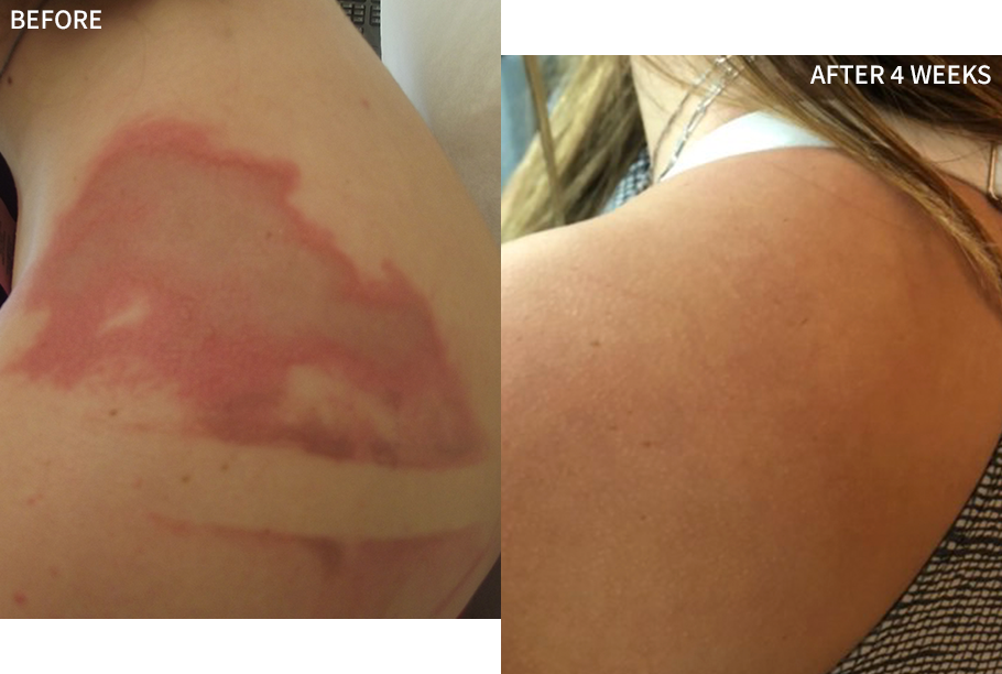 burn on a woman's shoulder before and after 4 weeks of treatment with RescueMD DNA Repair Complex