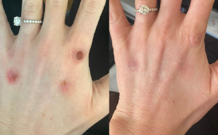 Clinical before and after photo showing successful skin healing on the back of a hand. The 'before' panel features prominent, raised, red-brown lesions on the knuckles and dorsum, while the 'after' panel shows the area completely healed with only minor, flat discoloration remaining.