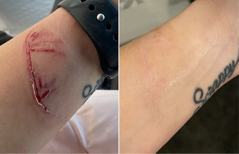 A side-by-side comparison of a forearm showing a fresh bloody scratch or cut on the left and a healed or faded tattoo-like mark on the right, with a black wristwatch visible in the left panel.